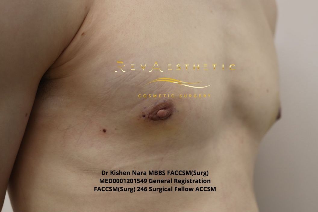 best before after gallery male breast reduction surgery liposuction gynaecomastia melb melbourne tasmania hobart launceston devonport brighton st kilda elwood glen waverley near me cosmetic plastic surgery