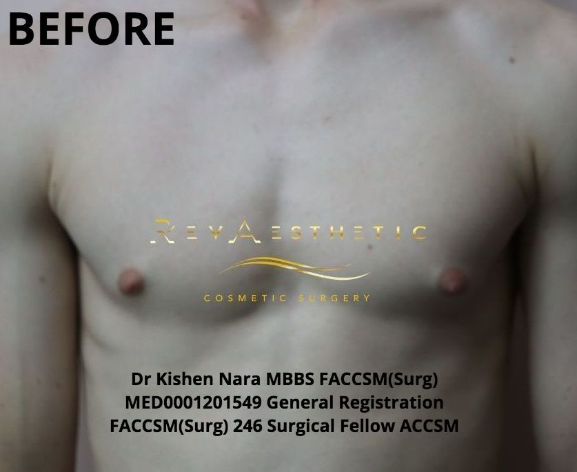 Before Gynaecomastia surgery performed by Dr Kishen Nara in Melbourne. Tailored assessments to provide the top options.