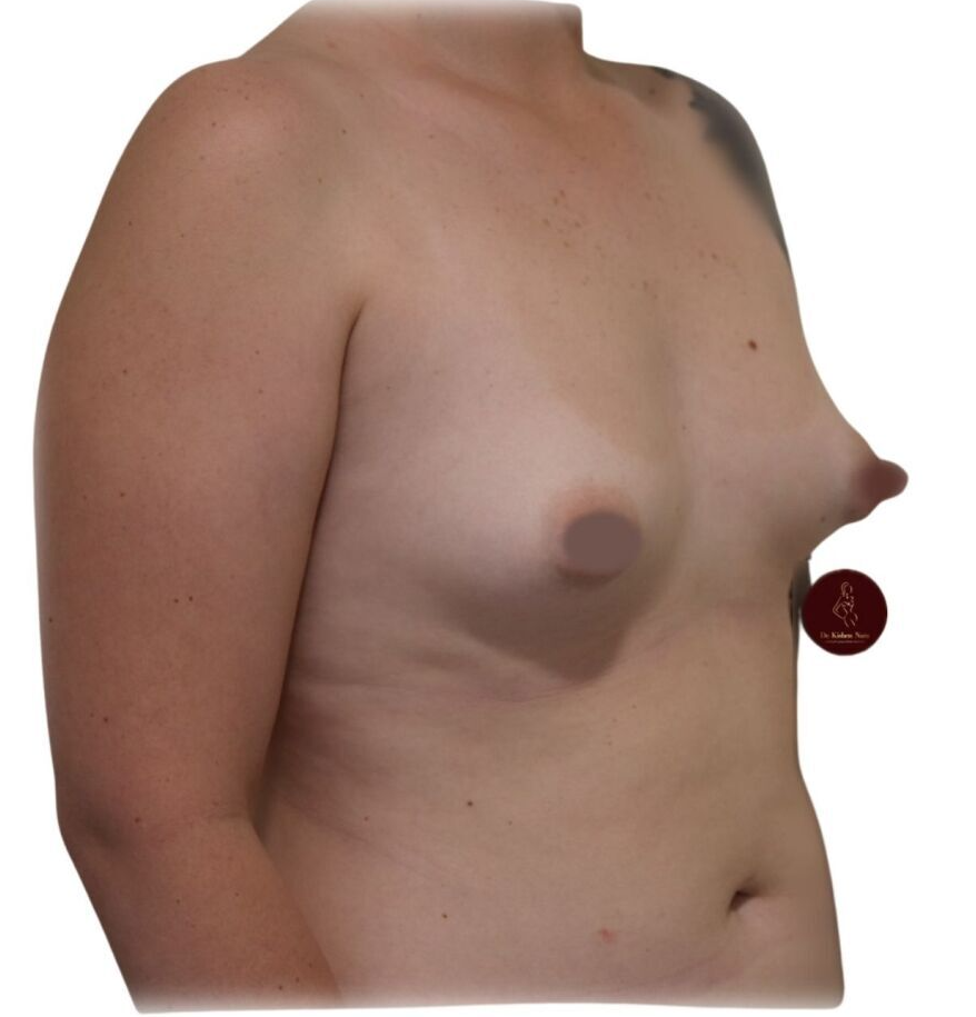 tuberous breast small breasts top best cosmetic surgeon melbourne tasmania