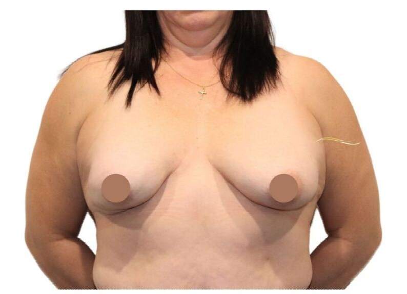 top surgeon tasmania cosmetic breast implant removal before after