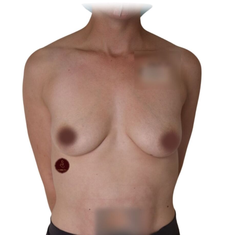 saggy breasts cosmetic plastic surgeon surgery melbourne tasmania