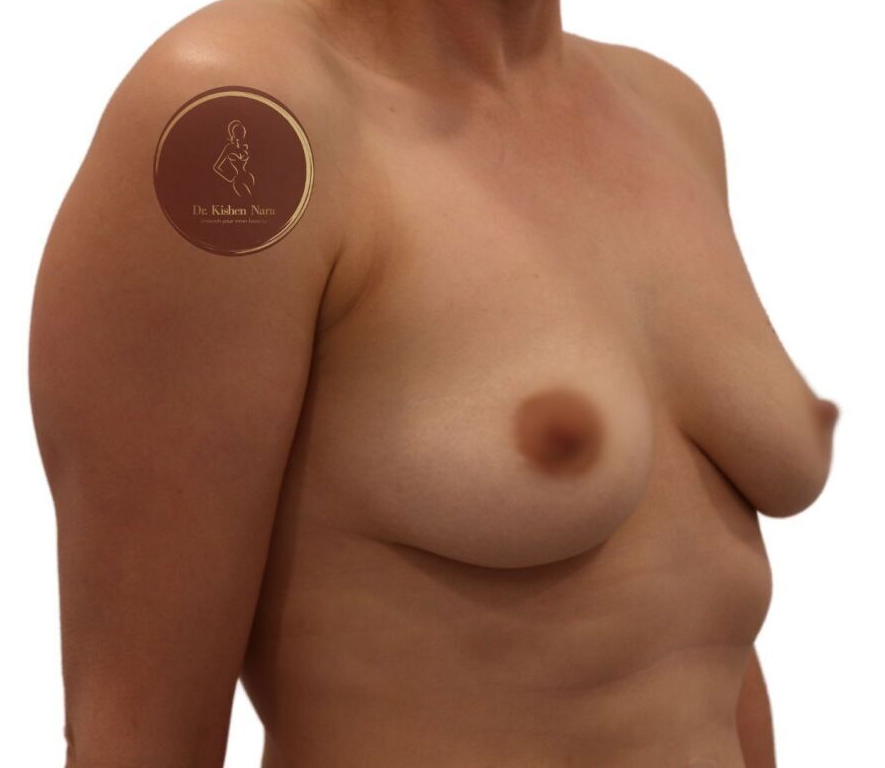 after children kids saggy breasts best cosmetic surgery melbourne tasmania