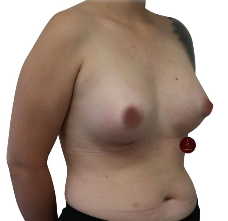 best cosmetic surgeon breast implants anatomical high profile silicone melbourne tasmania dr nara