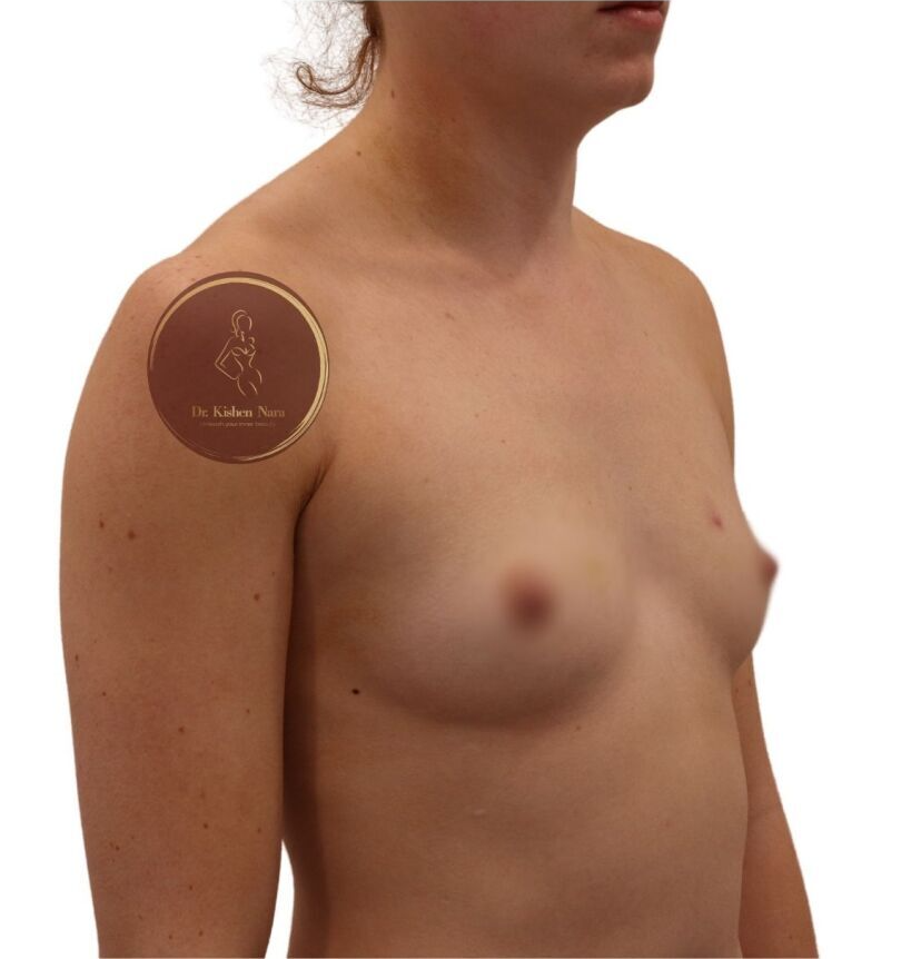 small breasts before children best cosmetic surgeon breast implants melbourne tasmania