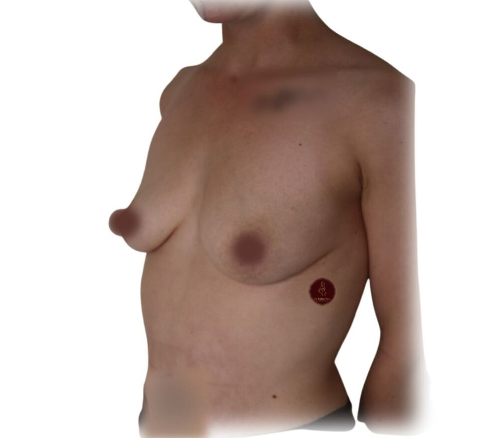 deflated chest kids women breast top cosmetic surgery breast implants melbourne tasmania