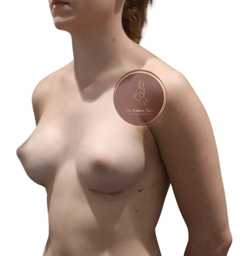 top cosmetic surgeon anatomical tear drop breast boobs implants augmentation fat graft melbourne tasmania