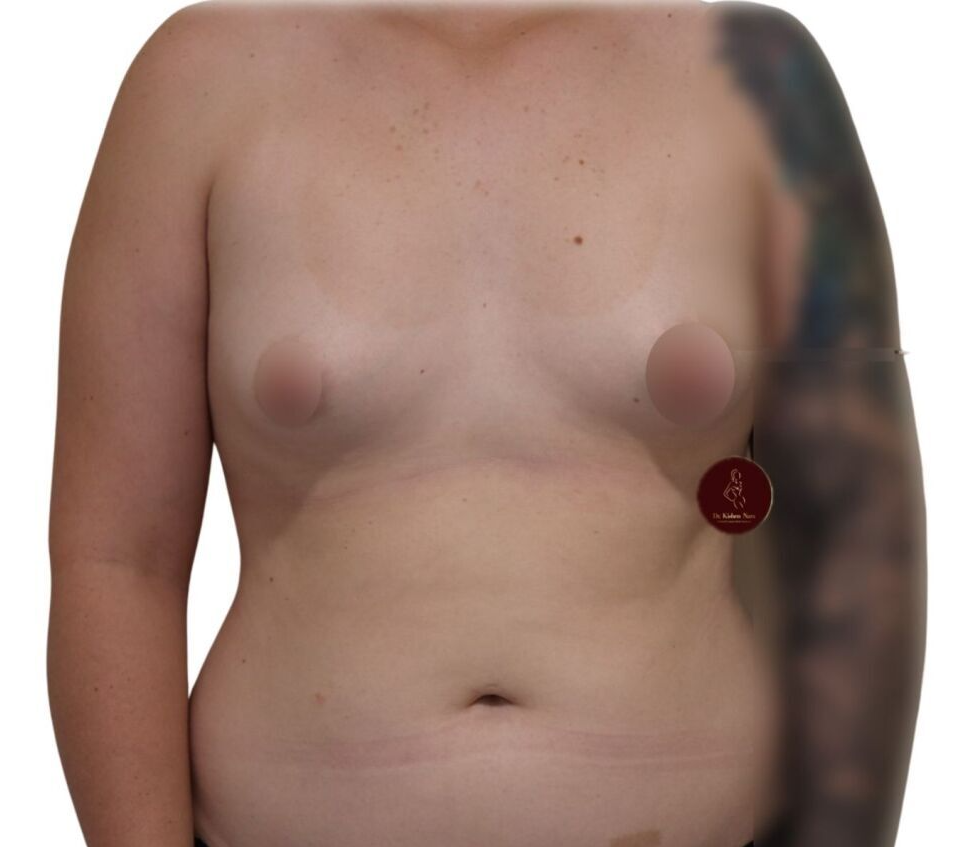 short nipple fold tuberous conical breast top best cosmetic surgery melbourne tasmania breast implants