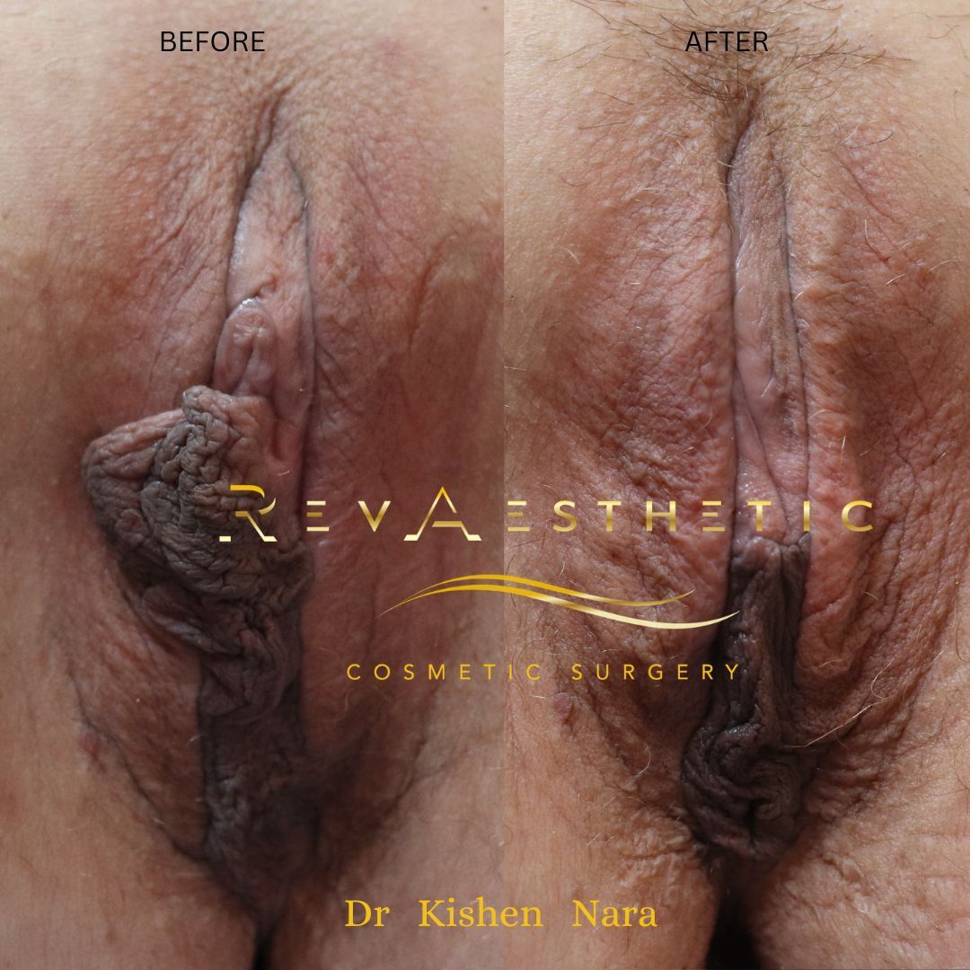 Top labiaplasty cosmetic surgeon Melbourne before after