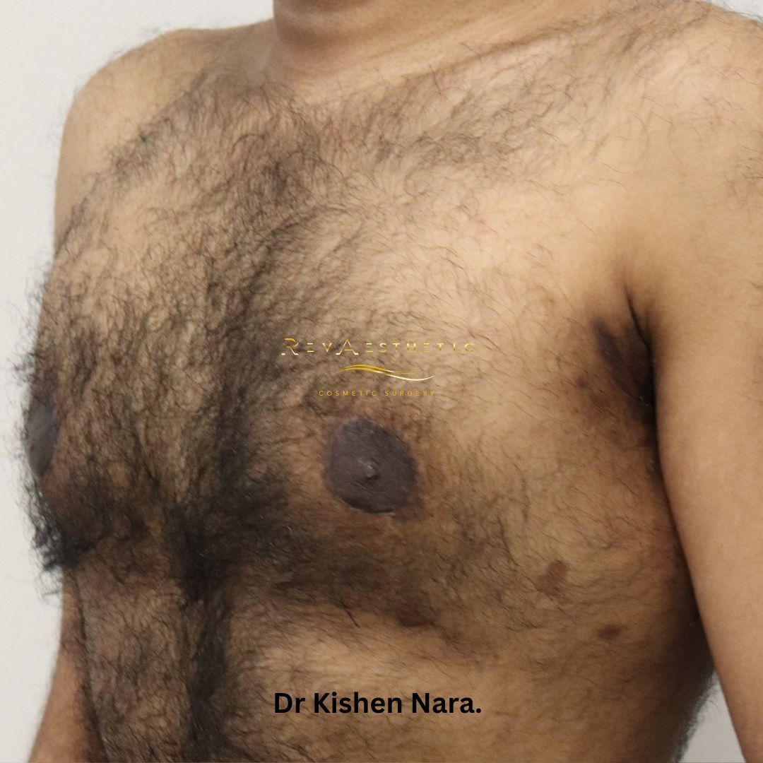 Gynaecomastia, liposuction, breast reduction, subcutaneous mastectomy, areolar reduction, manboob surgery, man boob cosmetic surgery surgeon melbourne tasmania