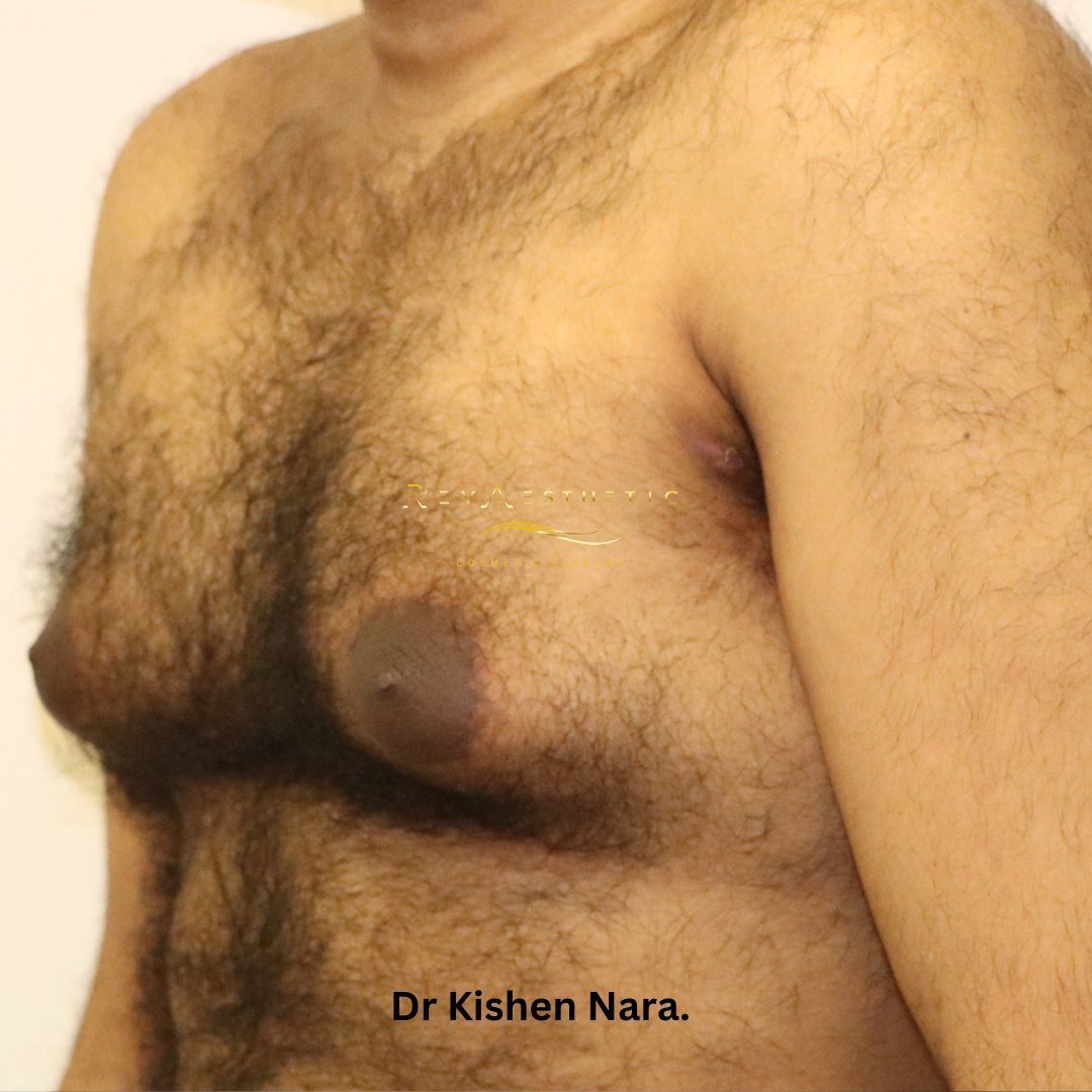 Gynaecomastia, liposuction, breast reduction, subcutaneous mastectomy, areolar reduction best manboob surgery melbourne tasmania cosmetic surgeon