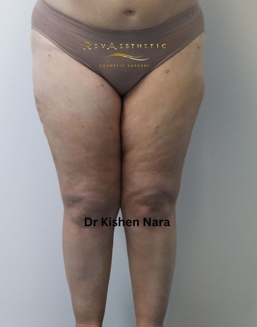 Top Liposuction of thighs before after gallery Melbourne South Yarra, Burnley, Elwood, Ashwood, Mount Waverley, Essendon, Toorak, Richmond and Glen Waverley