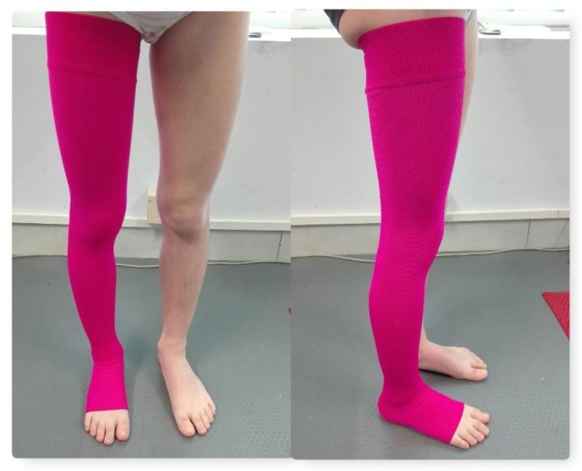 Calza elastocompressiva per flebite
