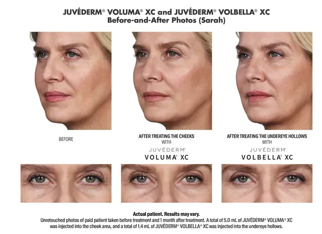 Fillers 1 | Northshore Dermatology