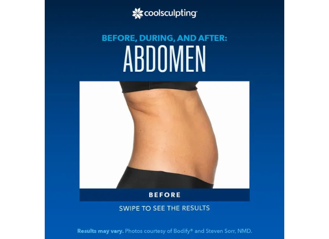 CoolSculpting 1 | Northshore Dermatology