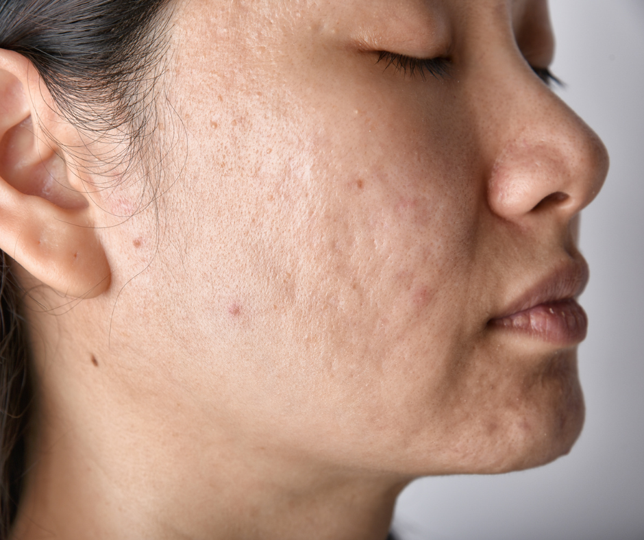Cysts | Northshore Dermatology | Service Page