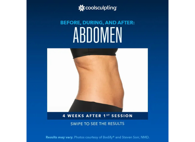 CoolSculpting 2 | Northshore Dermatology