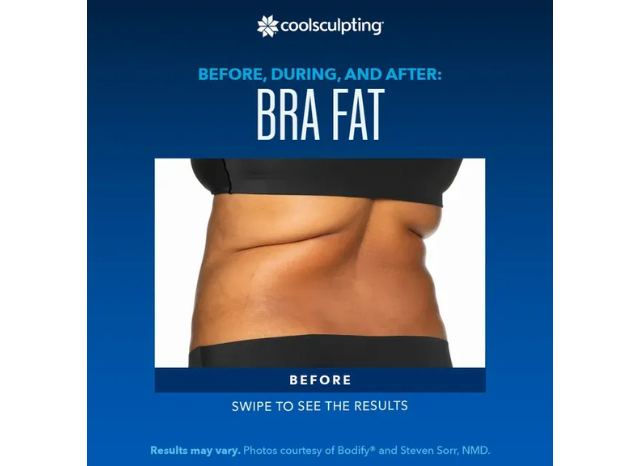 CoolSculpting 5 | Northshore Dermatology