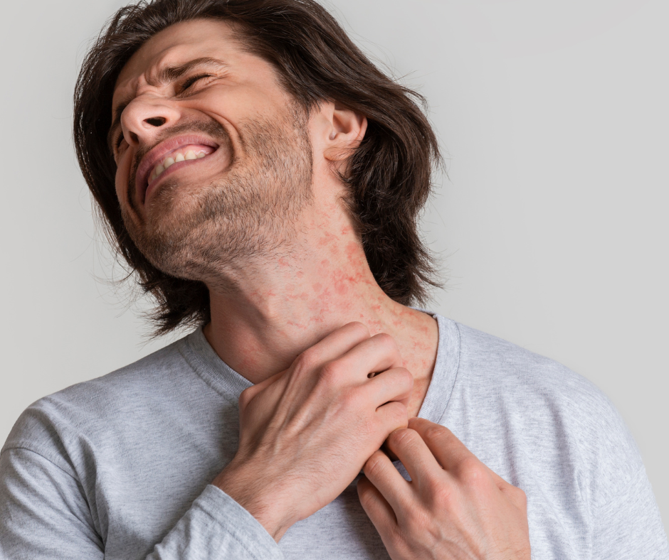 Eczema | Northshore Dermatology | Service Page