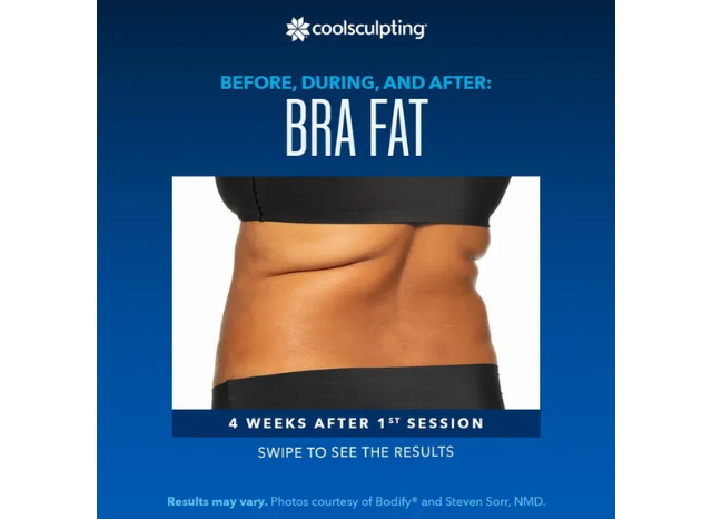 CoolSculpting 6 | Northshore Dermatology