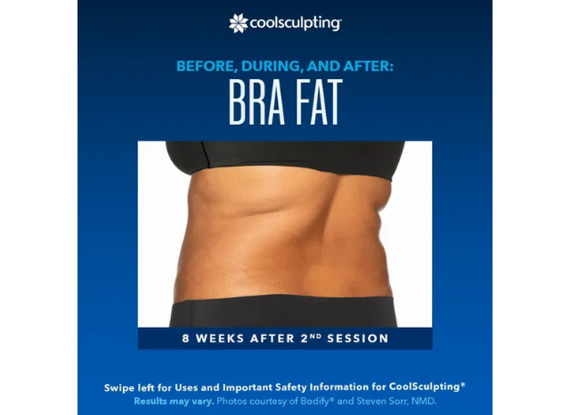 CoolSculpting 7 | Northshore Dermatology