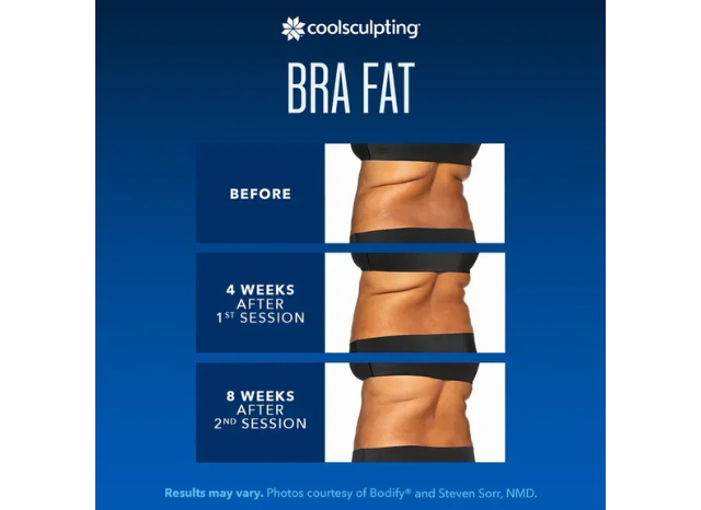 CoolSculpting 8 | Northshore Dermatology