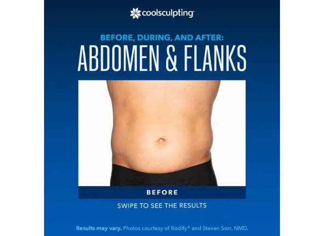 CoolSculpting 9 | Northshore Dermatology