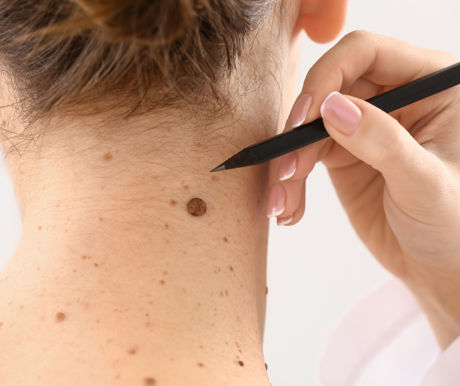 Moles | Northshore Dermatology | Service Page