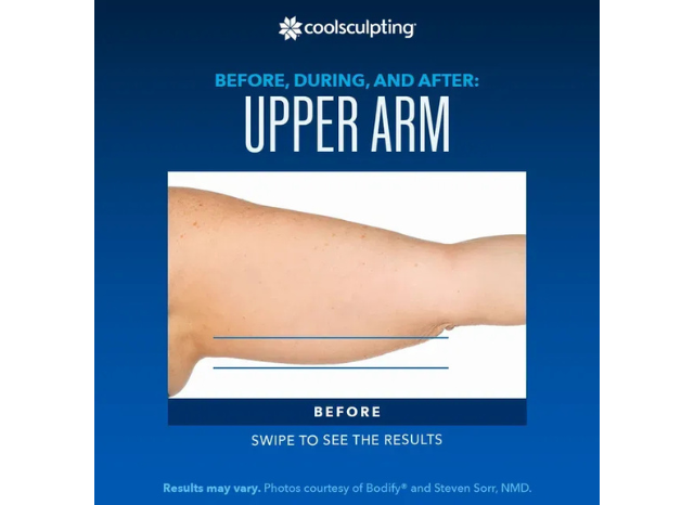 CoolSculpting 13 | Northshore Dermatology