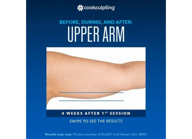 CoolSculpting 14 | Northshore Dermatology