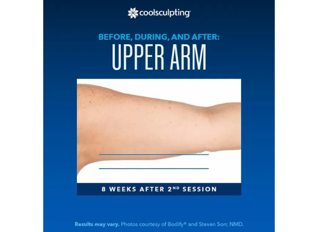 CoolSculpting 15 | Northshore Dermatology