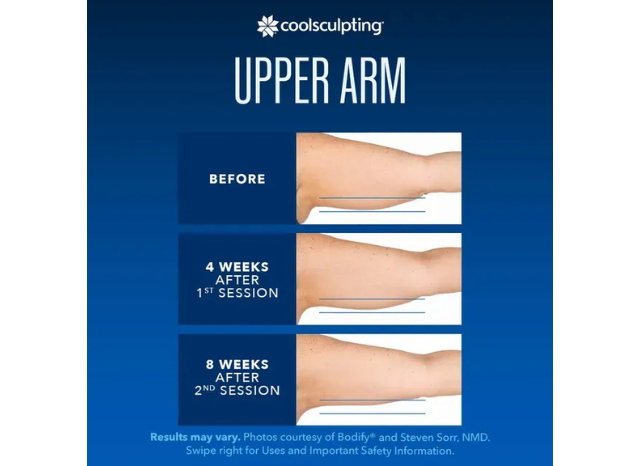 CoolSculpting 16 | Northshore Dermatology