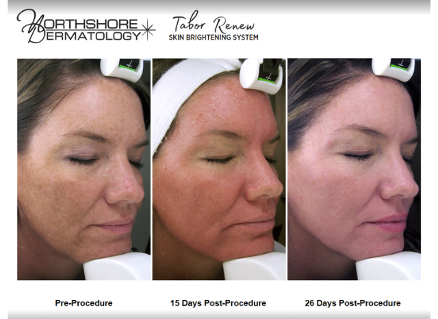 Tabor Peels 1 | Northshore Dermatology