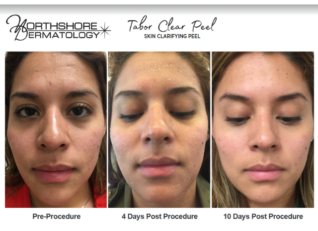 Tabor Peels 3 | Northshore Dermatology