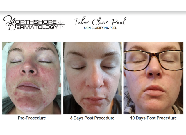 Tabor Peels 4 | Northshore Dermatology