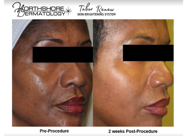 Tabor Peels 5 | Northshore Dermatology