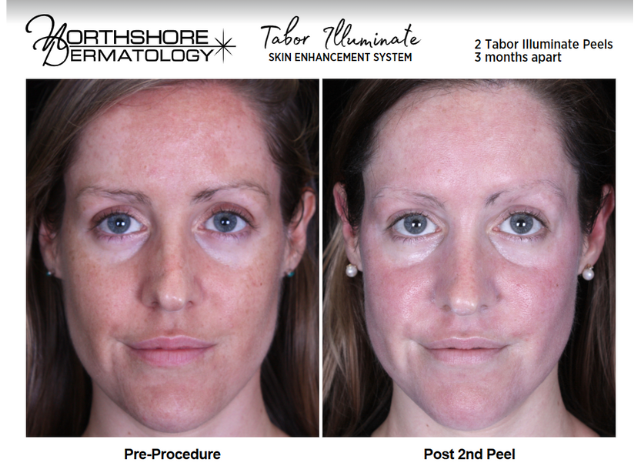 Tabor Peels 6 | Northshore Dermatology