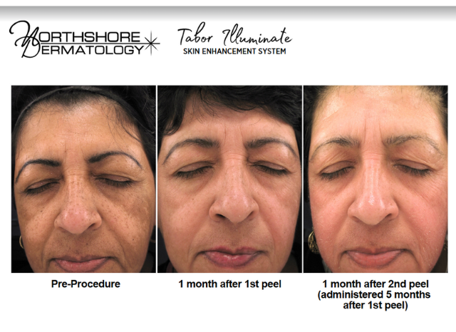 Tabor Peels 8 | Northshore Dermatology