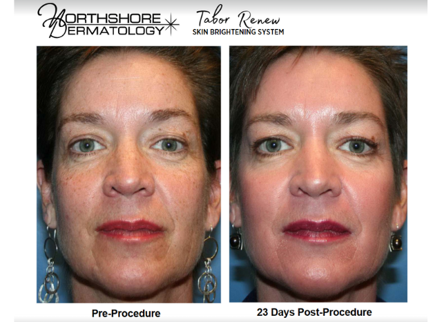 Tabor Peels 9 | Northshore Dermatology