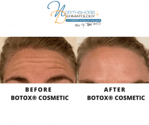 Before and After Injection 6 | Northshore Dermatology