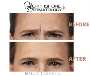 Before and After Injection 7 | Northshore Dermatology