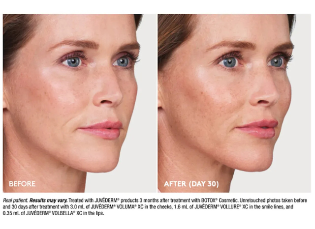 Fillers 4 | Northshore Dermatology