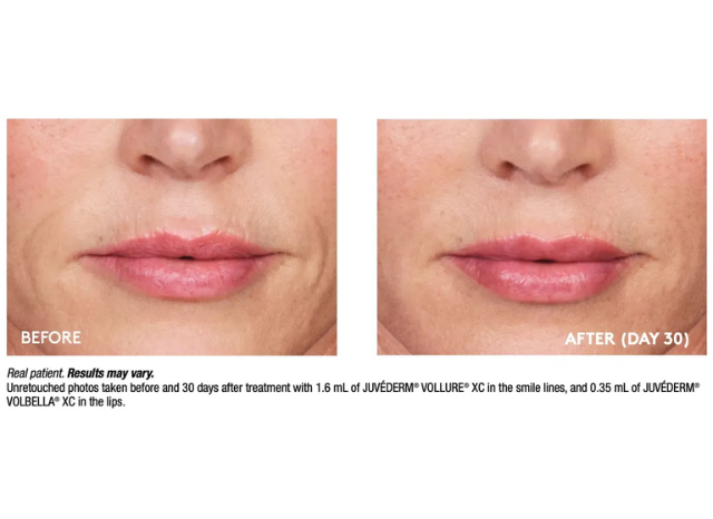 Fillers 5 | Northshore Dermatology