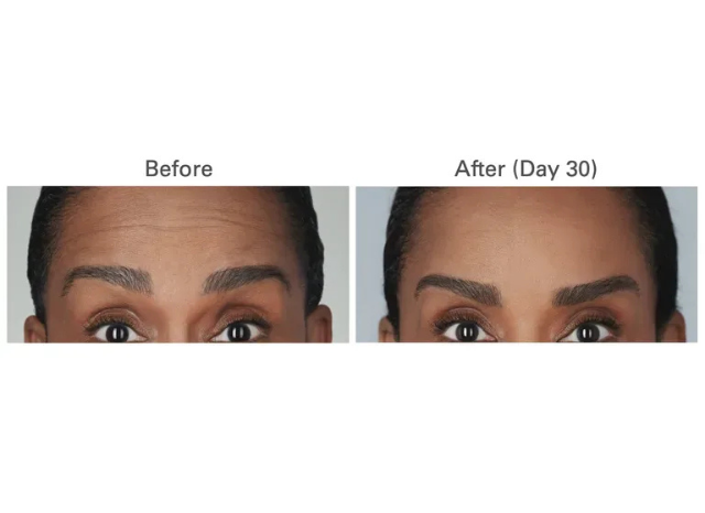 Botox 1 | Northshore Dermatology