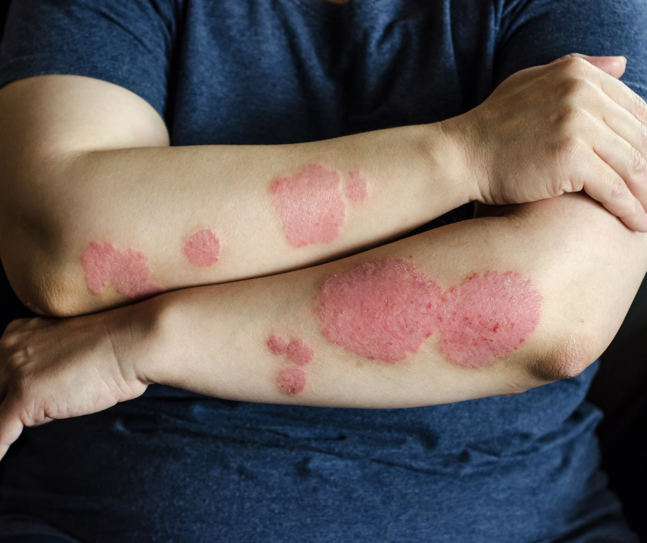 Five Major Types of Psoriasis | Northshore Dermatology