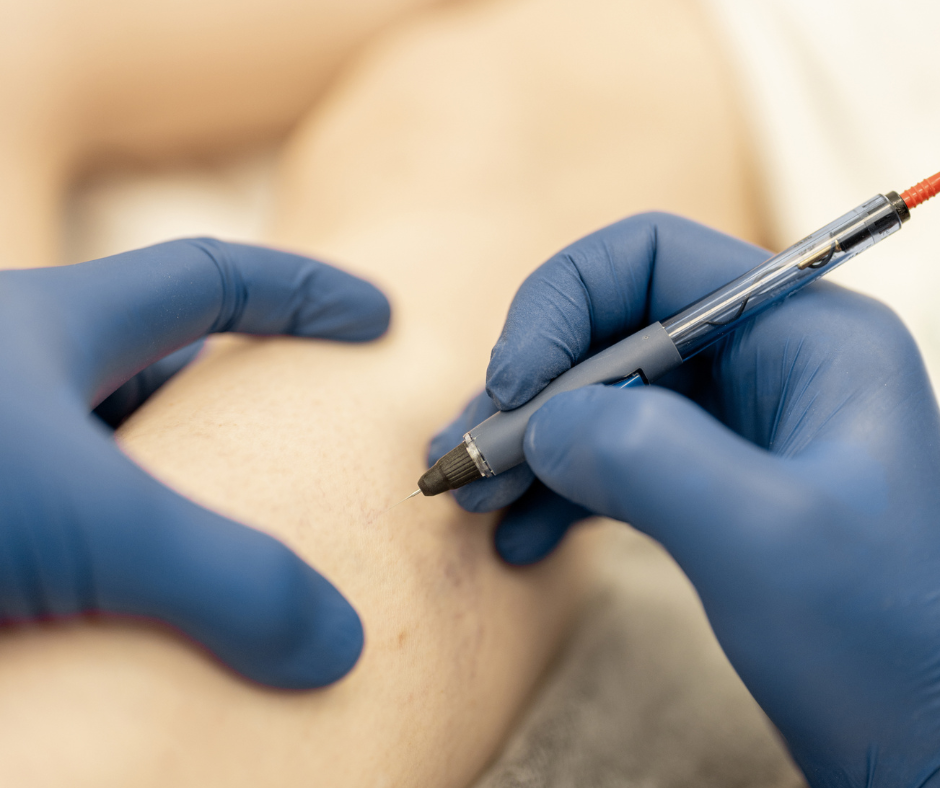 Sclerotherapy | Northshore Dermatology