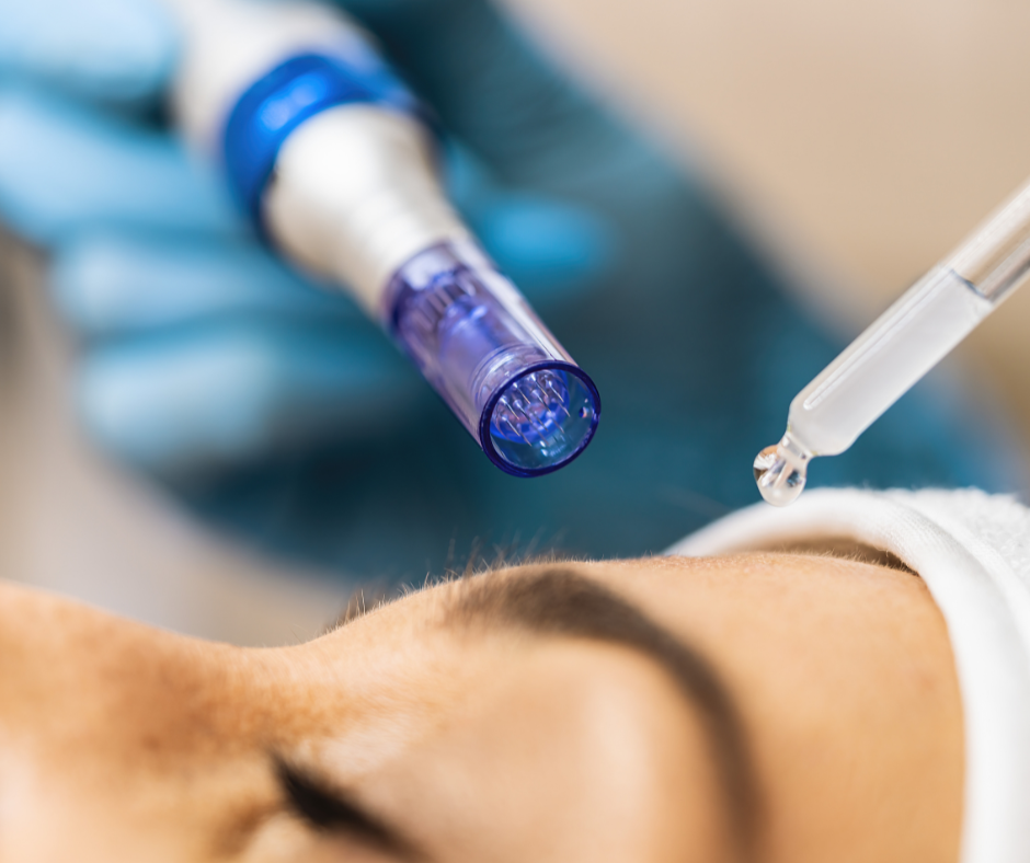 Microneedling with PRP | Northshore Dermatology