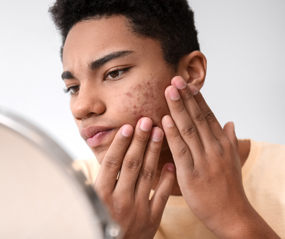 Acne | Northshore Dermatology | Service Page