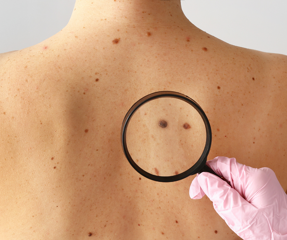 Are my Moles Harmful | Northshore Dermatology