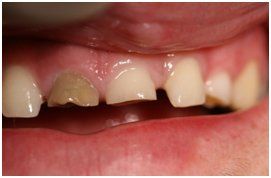 James-Murphy-DDS-Salisbury-NC-bonding-tooth-before