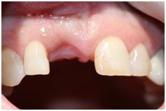 James-Murphy-DDS-Salisbury-NC-Dental Implant-before